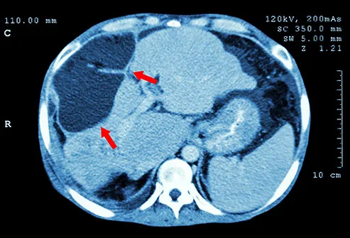 liver cancer ct scan