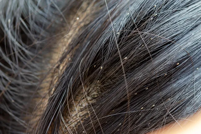 photo of nits in hair