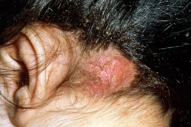 photo of allergic reaction to head lice