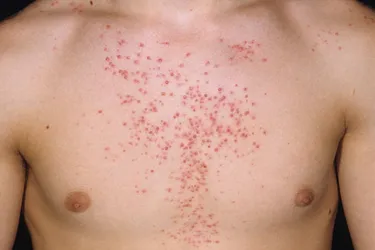 Steroid cream induced acne