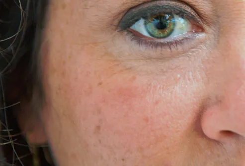Anti-Aging Pictures: Get Rid of Wrinkles, Dark Circles 