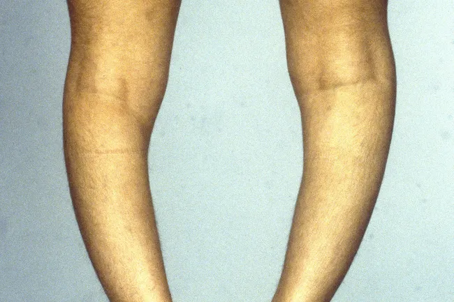 photo of legs with osteomalacia