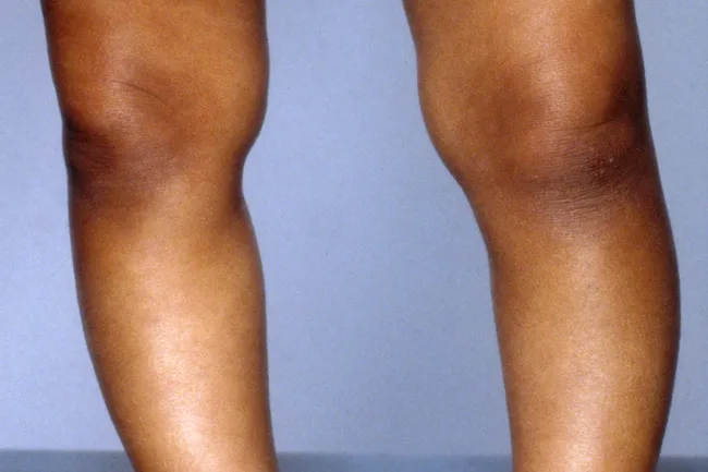 photo of legs with rickets