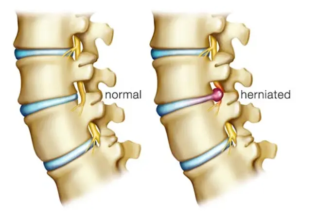 Back Pain Culprit: Herniated Disk