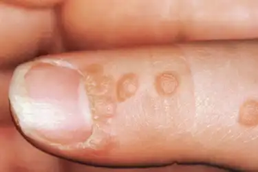 wart skin like bumps)