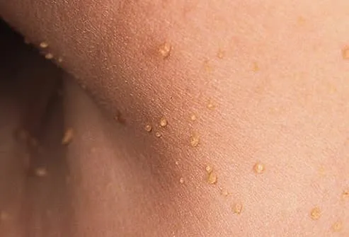 skin tags on womans neck