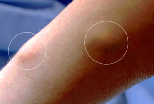 Hpv vaccine knot in arm