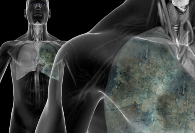 Lung Cancer Pictures: X-Rays of Tumors, Screening 
