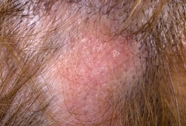 Lupus Symptom: Hair Loss