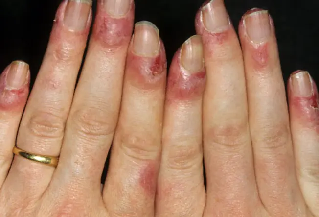 Lupus Symptom: Nail Changes