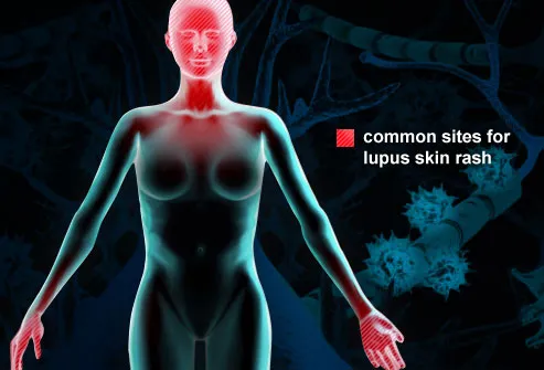 Lupus In Explained In Pictures Rashes Location Pain Nail
