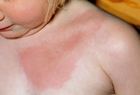 Lyme disease erythema rash on young girl's chest