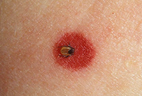 lyme disease tick bite
