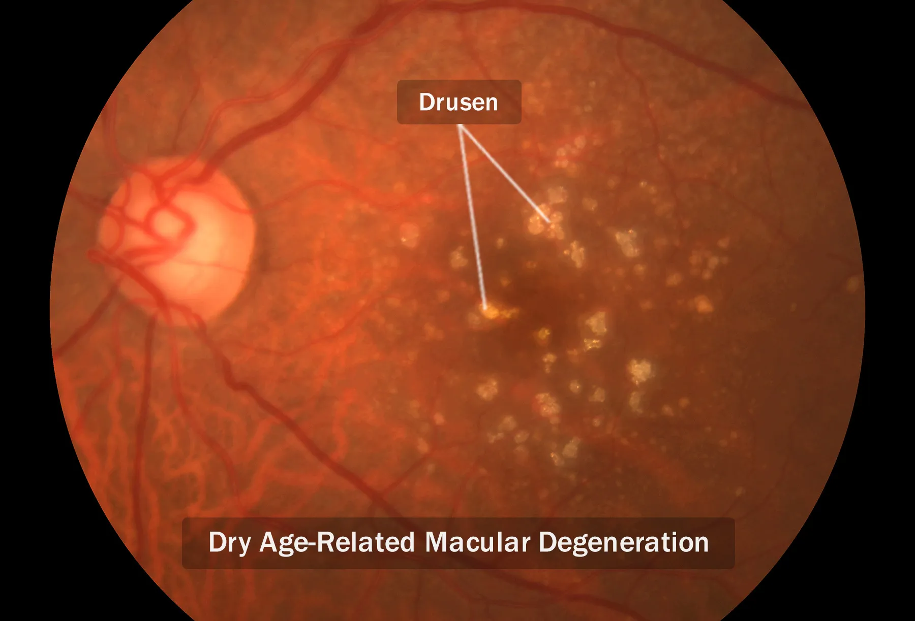 dry macular degeneration