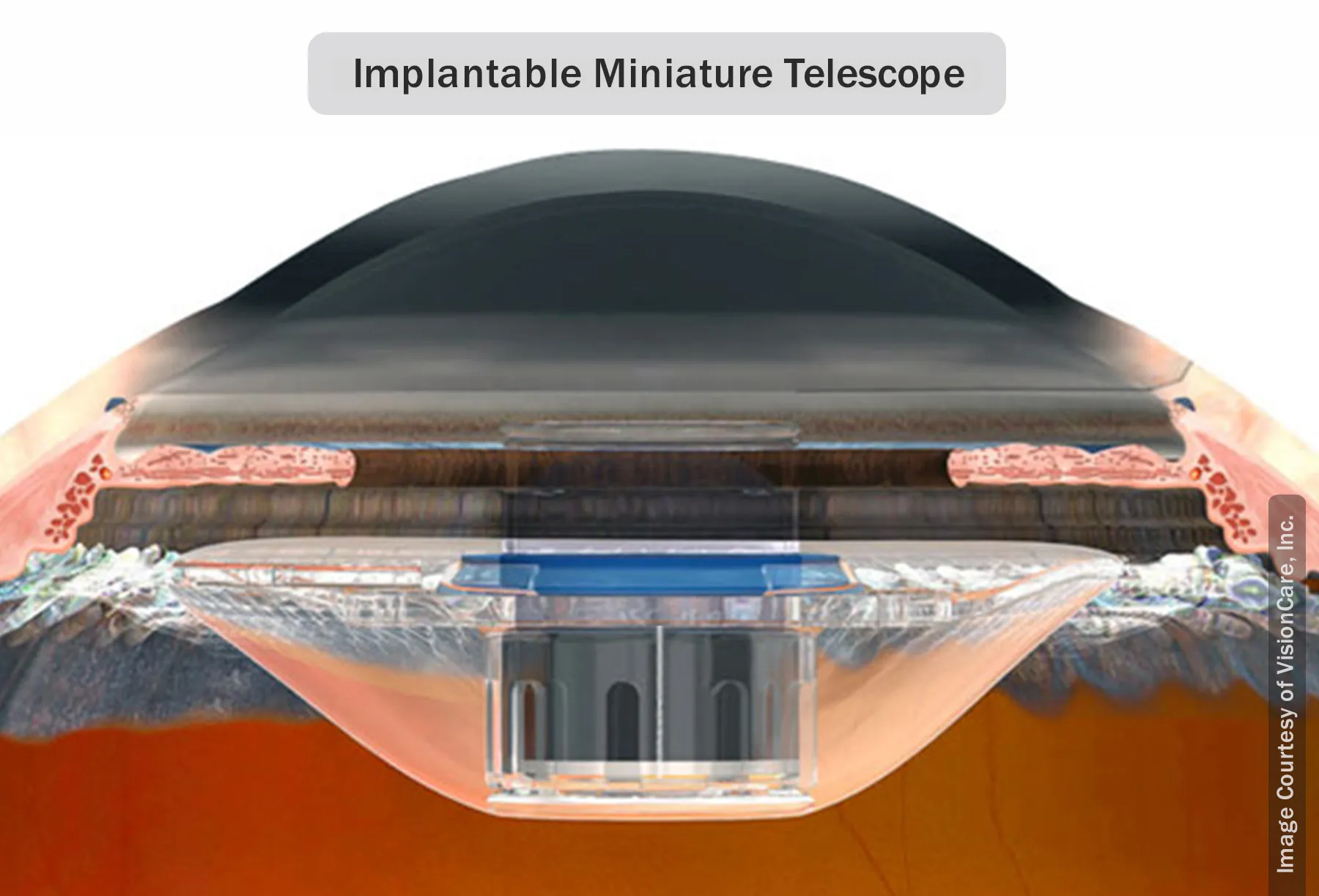 implantable miniature telescope