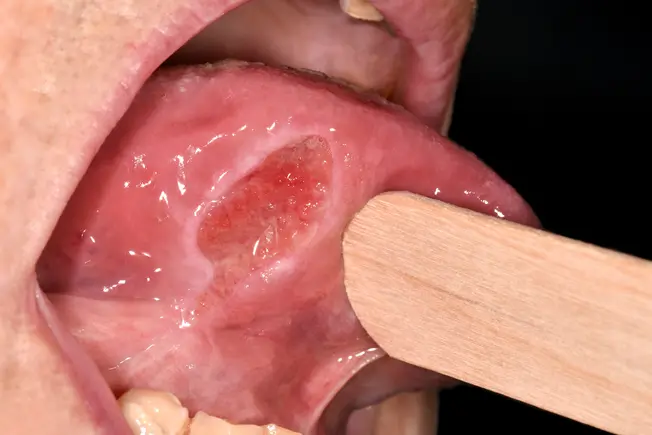 What Do Ulcers Look Like?