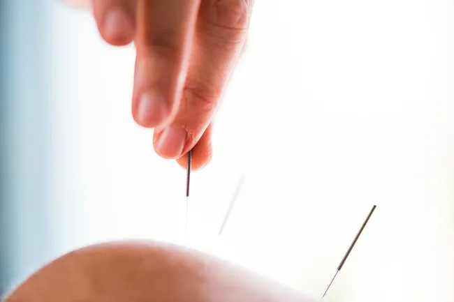 photo of acupuncture
