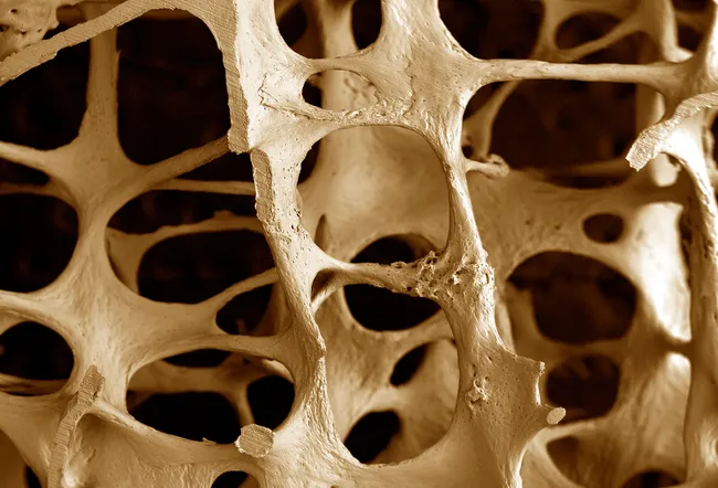 Scanning electron micrograph (SEM) of osteoporosis