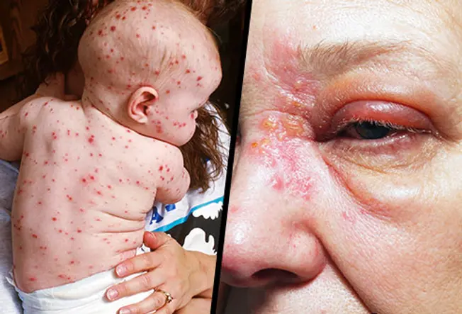 Myth: Chickenpox Is the Same Thing