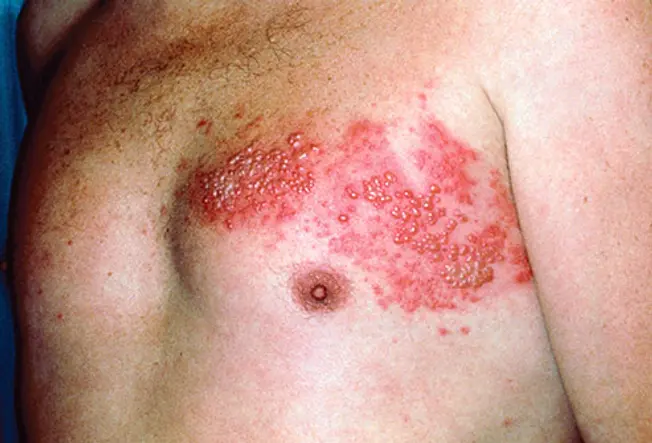 What Is Shingles?