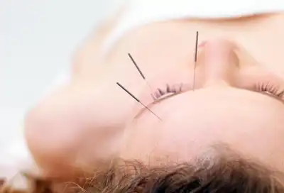 woman receiving acupuncture