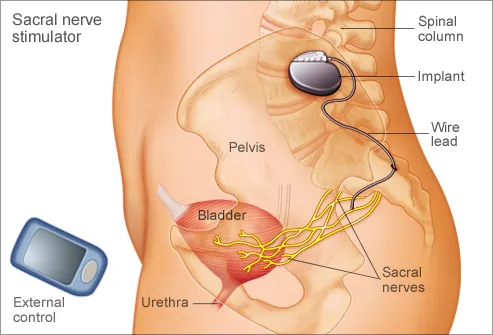 How To Help an Overactive Bladder