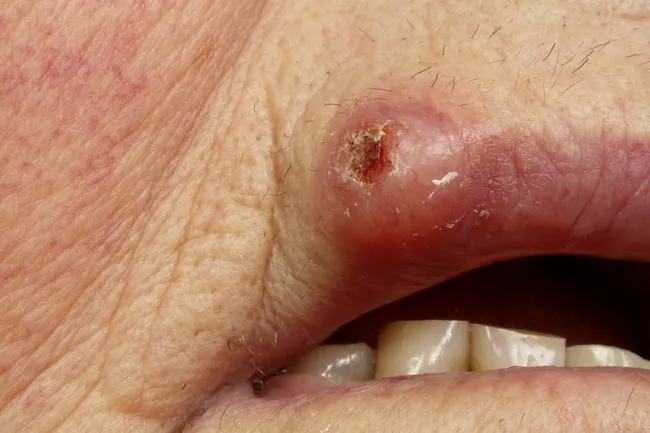 Download Small Hpv Bumps On Lips Pics