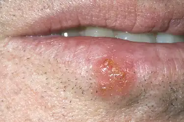 Lip clear bump on Fibrous papule
