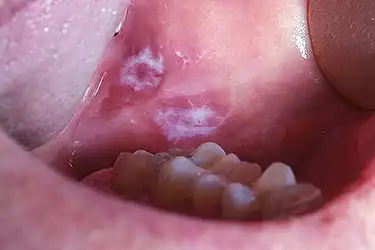Tongue blister under small clear Clear Bubble