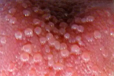 17 Mouth & Tongue Problems: Pictures of Sores, Blisters, Bumps, and Mor...