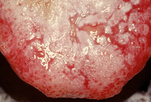 oral gonorrhea symptoms white tounge
