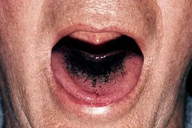 Tongue water blister under Painful or