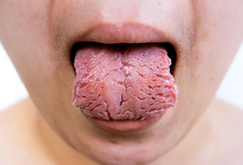 Pictures: What Your Tongue Says About Your Health