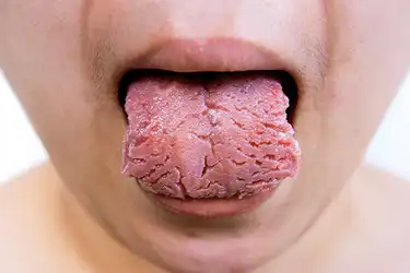 Tongue blister under small clear How to