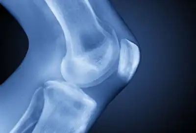 X-Ray of Human Knee