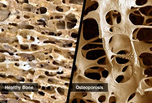 osteoporosis diptych
