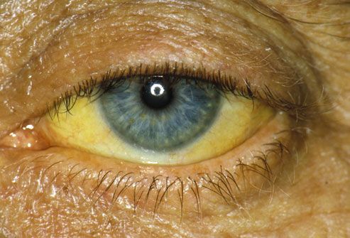 Yellow eye due to obstructive jaundice