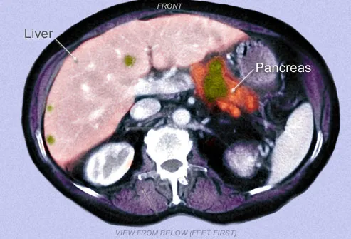 Colored CT scan of metastatic pancreatic cancer 