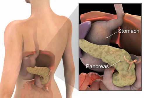 pancreatic cancer abdominal distension)