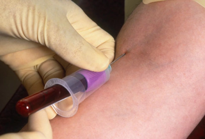 HIV Screening Tests