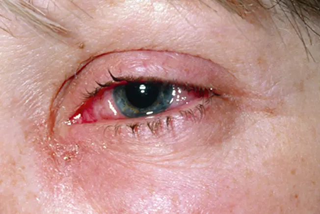 Symptom: Itchy or Burning Eyes