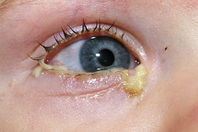 Symptom: Drainage from the Eyes