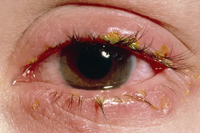 Symptom: Crusty Eyelids