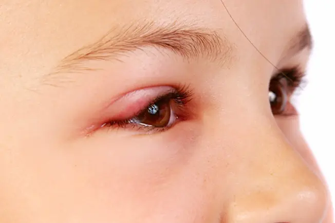 Symptom: Swollen, Red Eyelids