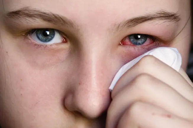 What Is Pinkeye?