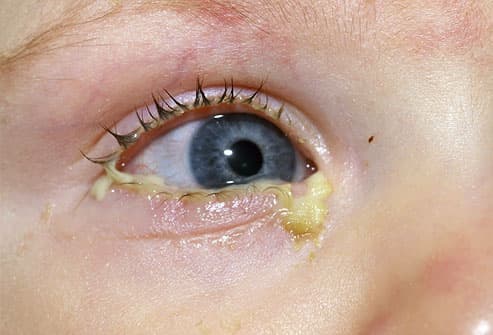 Acute bacterial conjunctivitis with pus around eye