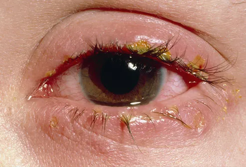 remah pada kelopak mata bengkak akibat infeksi virus