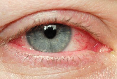 Eye redness, symptom of pinkeye