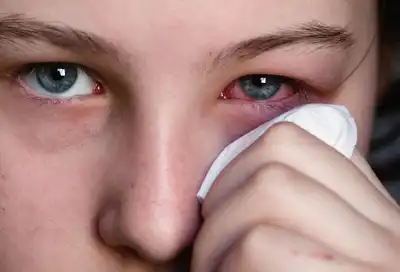 Woman holding tissue to irritated eye