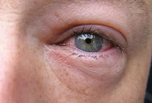 closeup view of heavy inflammation in the eye